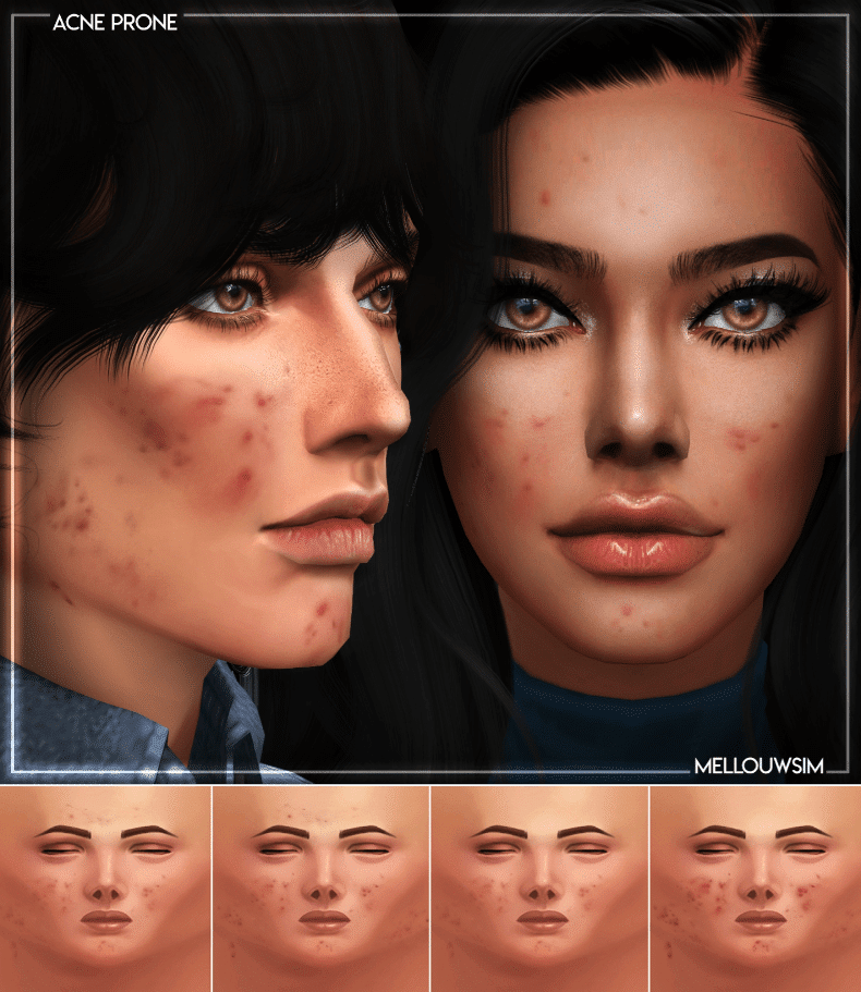 Acne Prone Skin Details for Male and Female [ALPHA]