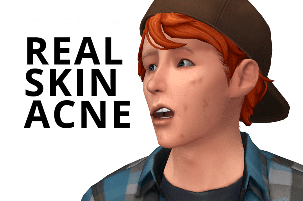 Real Acne Skin Detail [MM]