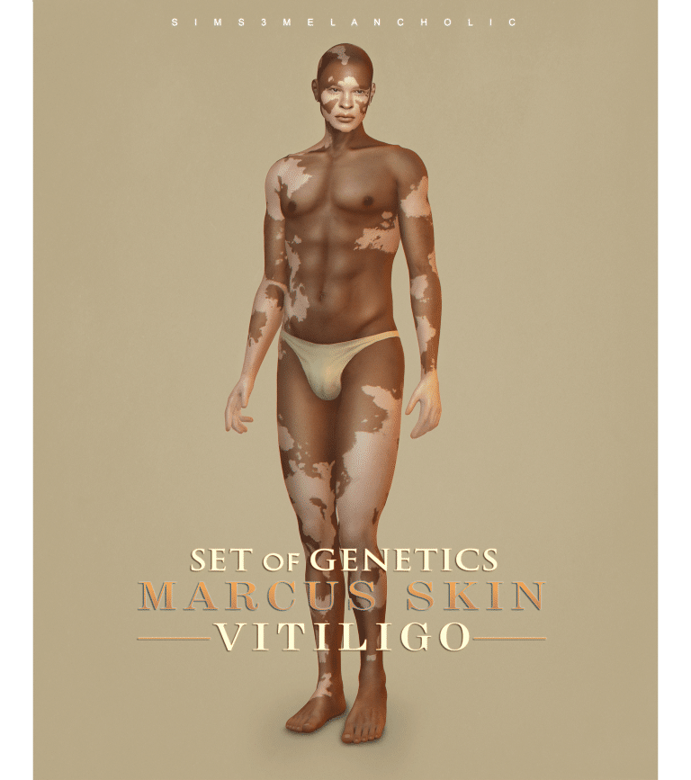 Marcus Skin Vitiligo