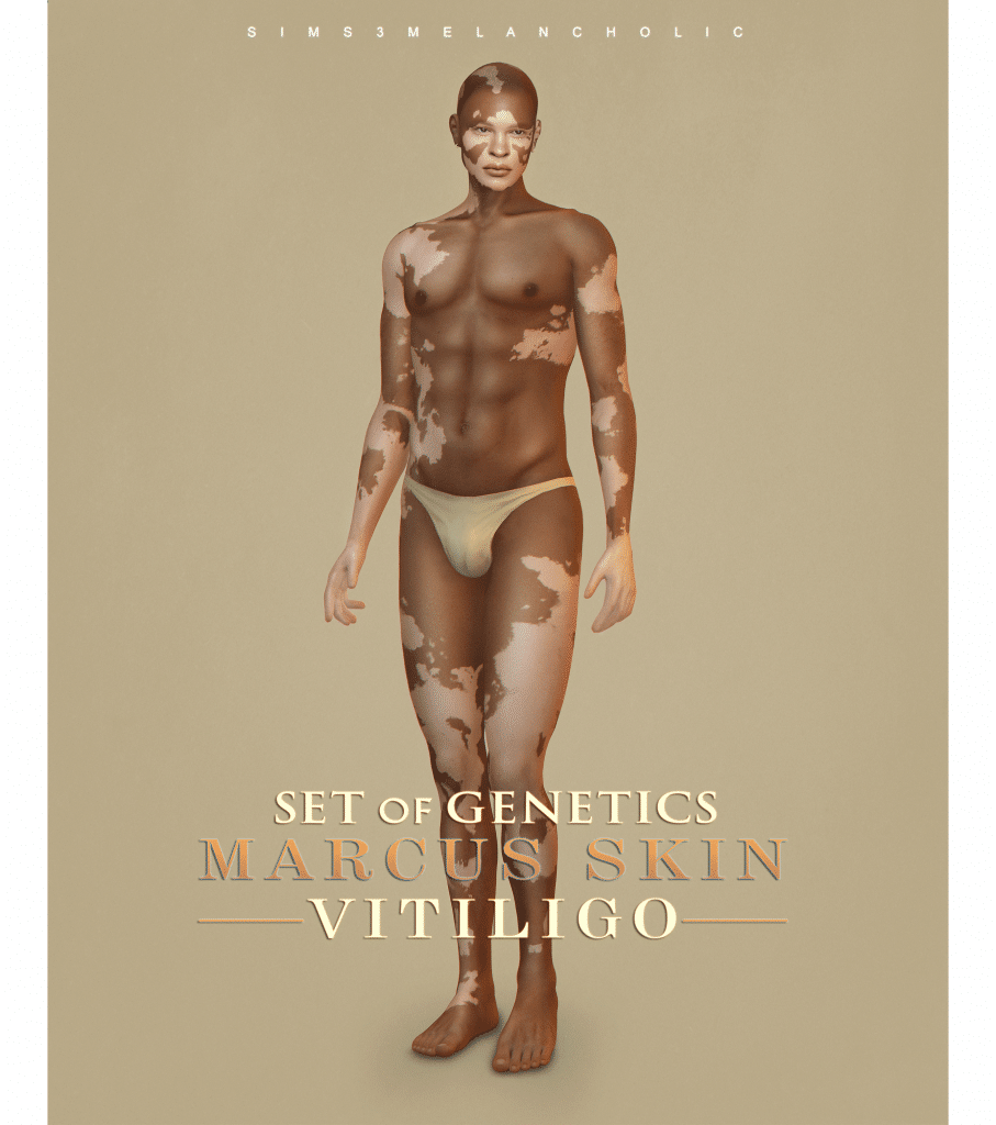 Marcus Skin Vitiligo