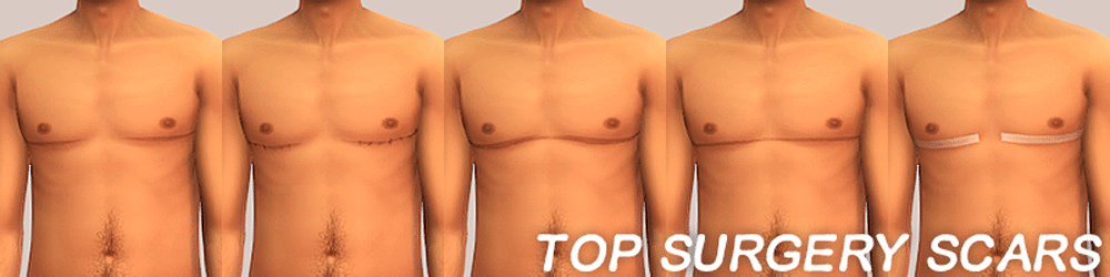 Top Surgery Scars